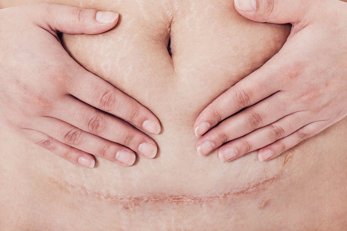 Women are sharing c-section scar selfies to challenge perceptions about  caesareans
