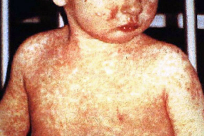Child shows a classic day-four rash with measles.
