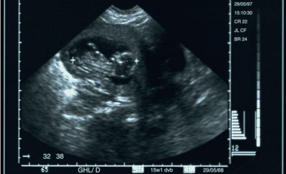 An ultrasound.
