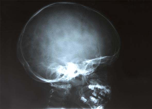 Child's head x-ray
