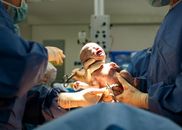 Baby being born via Caesarean Section.