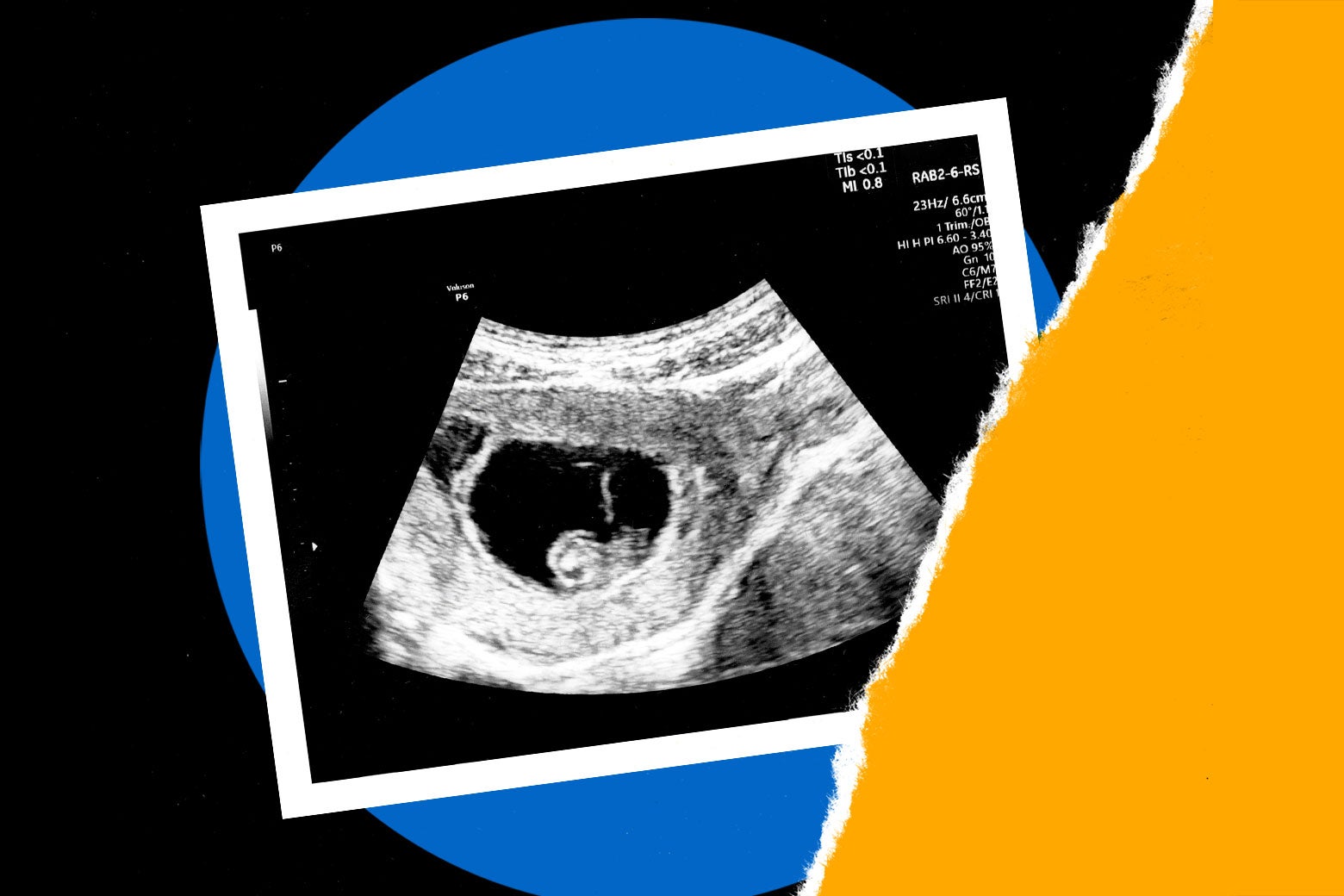 The Future of IVF Post-Roe