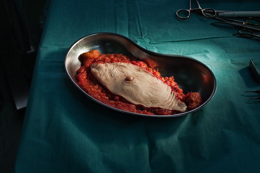 Breast cancer (whole breast removed). 