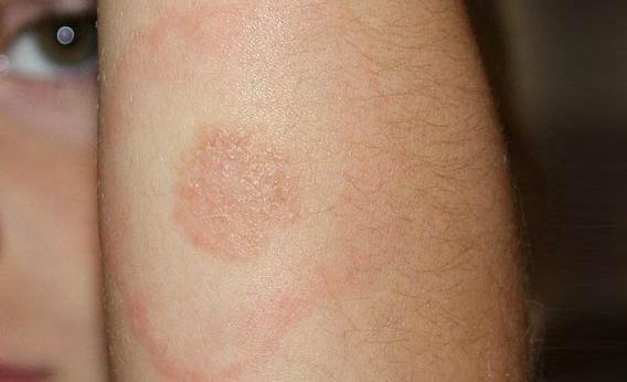 Lyme Disease type rash on a 5-year-old's arm. 