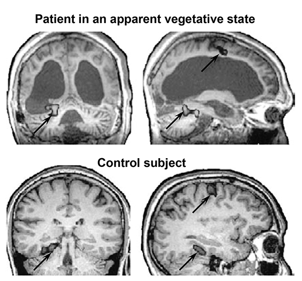 coma patients brain activity