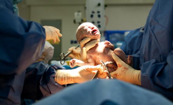 Baby being born via Caesarean Section.