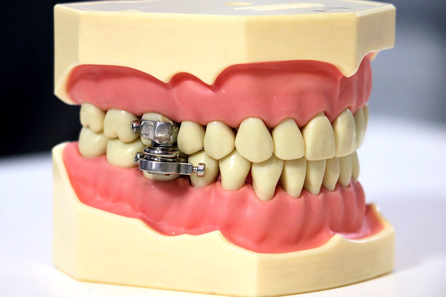 A model of a jaw and teeth with the magnetic lock holding the jaw together.