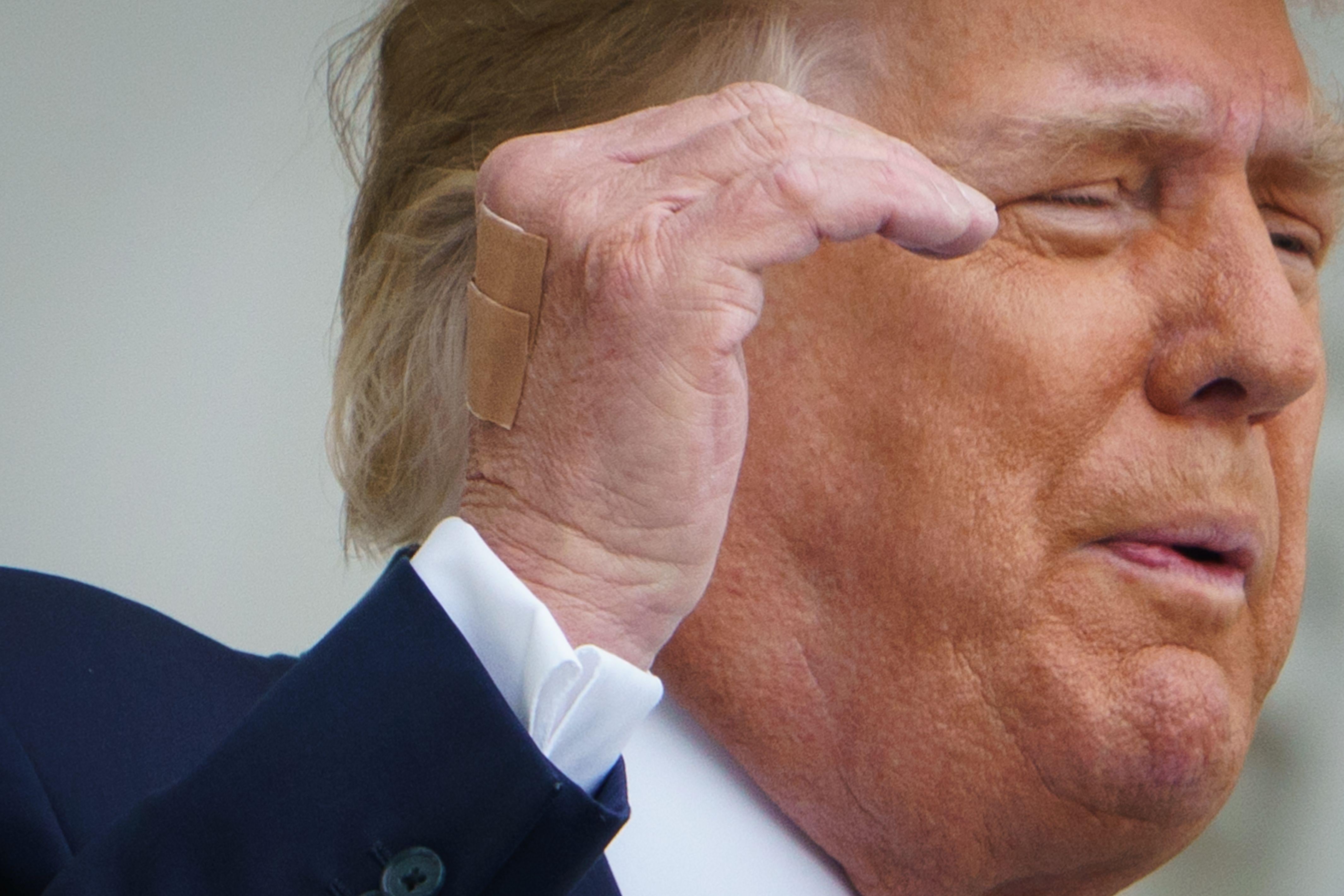 Bandages are seen on the back of his hand as President Donald Trump speaks from the South Portico of the White House in Washington, DC during a rally on October 10, 2020.