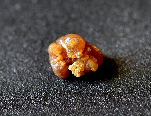 passing kidney stones at home