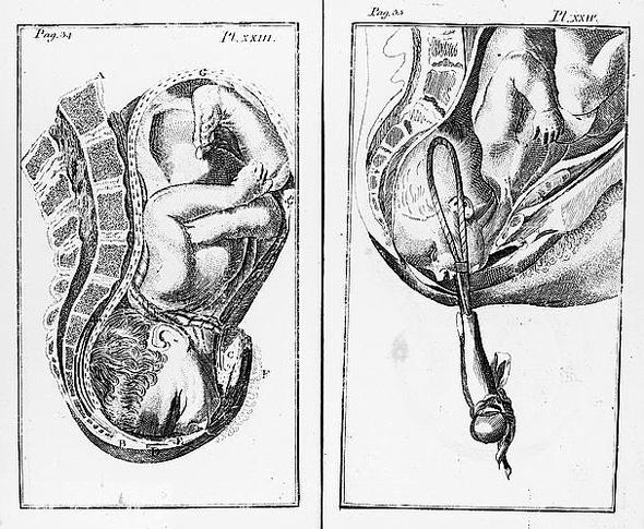Two images of childbirth: plate 23 (left) shows child in womb with umbilical cord and plate 24 (right) shows forceps being used to deliver child.