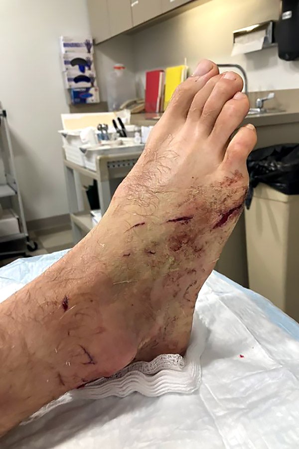 A foot on a hospital bed with visible bite marks.