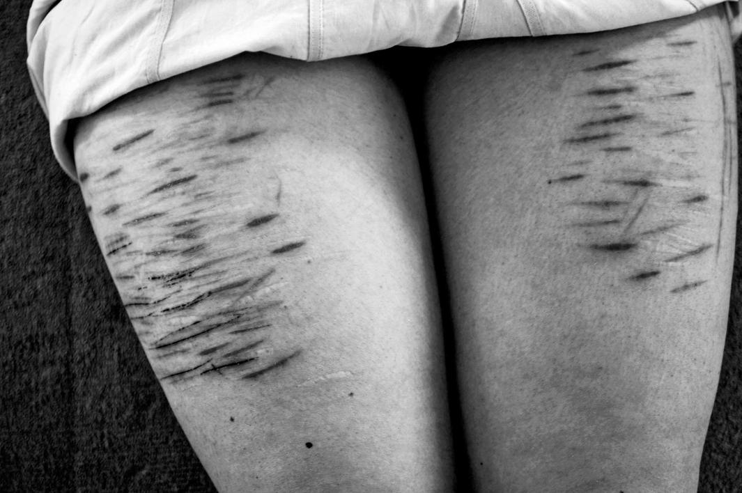 December 2008 The mutilated legs of Susanna. Initiated into a satanic cult at the age of eight, twenty-four-year-old Susanna developed DID as a coping mechanism and has over 200 identities, many of which are self-mutilators. The initiations involved many forms of sexual abuse, including bestiality, gang rapes, and child pornography.