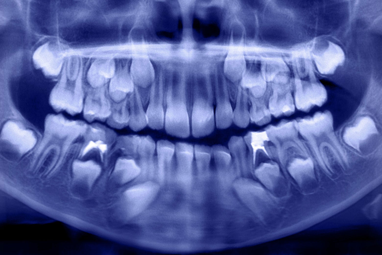 An X-ray of a child's mouth, containing baby and adult teeth.