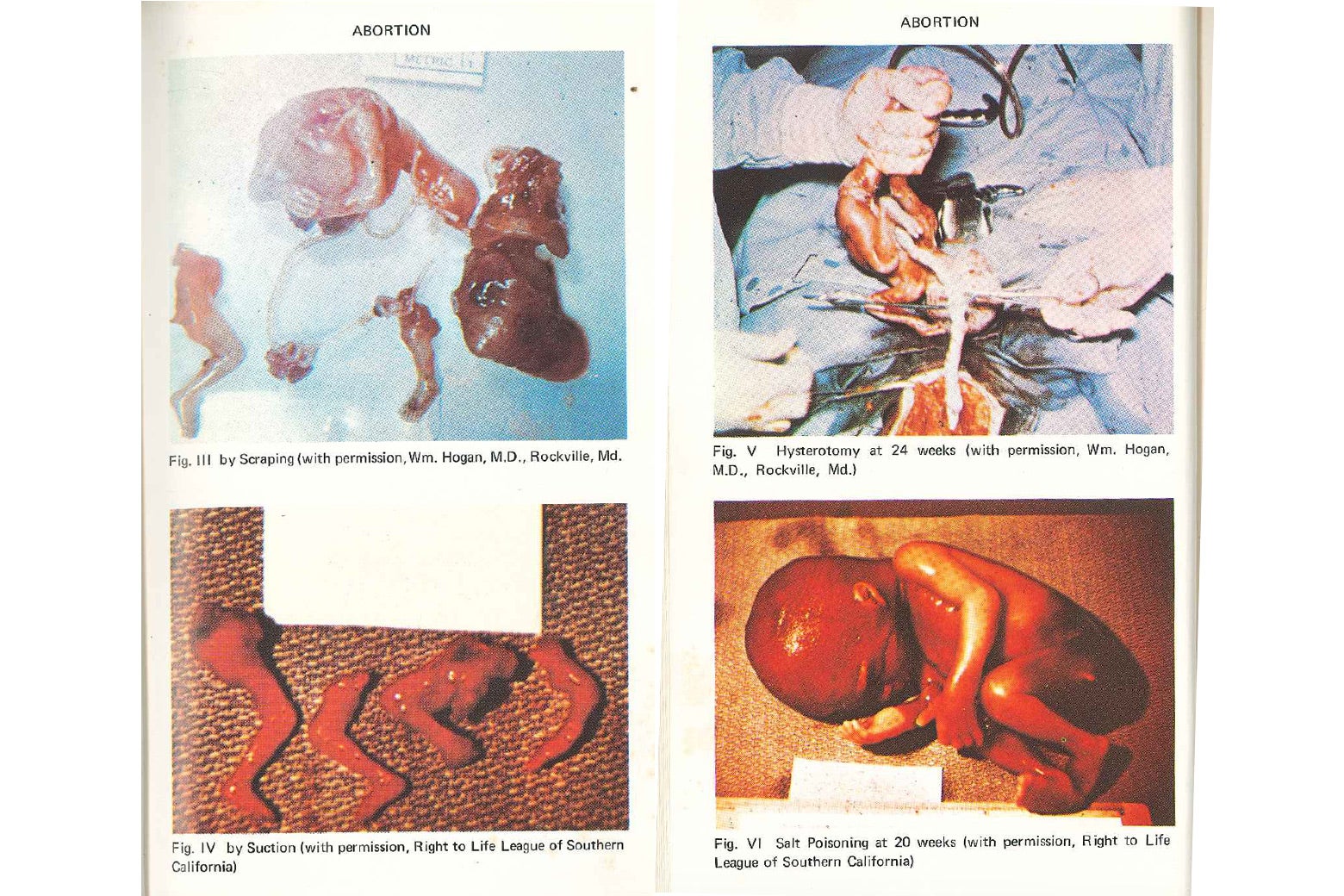 photos from the Handbook on Abortion show four different methods of abortion: By suction, by scraping, a hysterectomy, and a saline abortion. The suction and scraping abortions show dismembered parts. The hysterectomy and the saline abortion show larger fetuses.