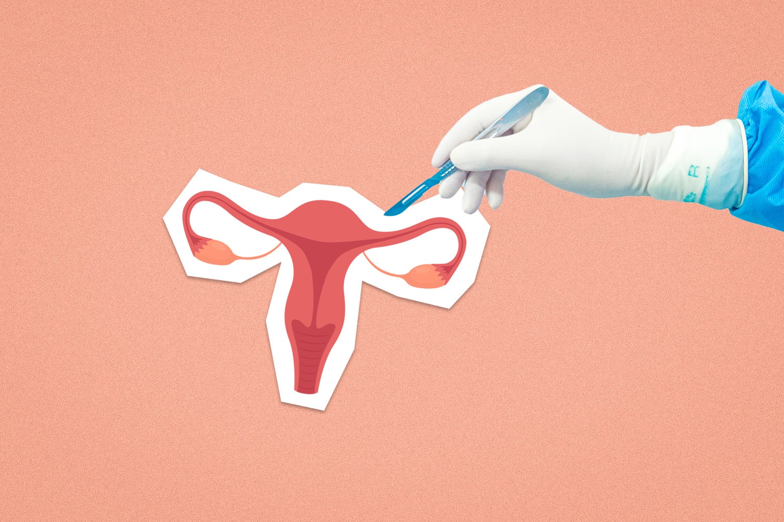 It's a Surgery That's Often Viewed as a Tragedy. For Many, It's Actually a Wonderful Choice.