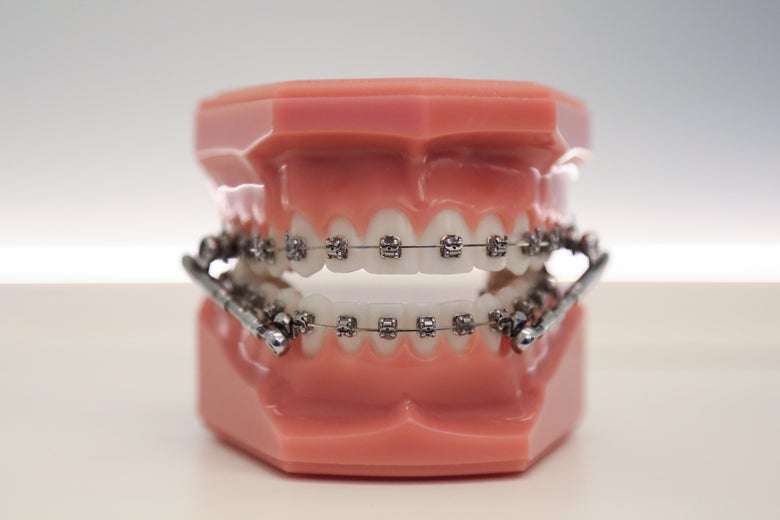 Are Braces a Scam?
