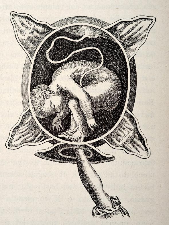 A medical engraving from The Court Midwife (by Justine Siegemund) illustrates a breech birth, 1690.