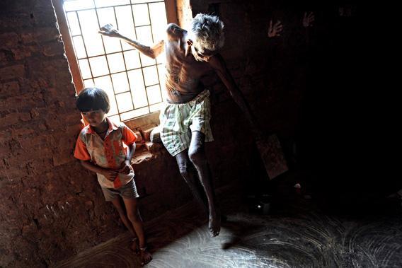 suffering from Leprosy, waits next to a window as a team of unseen doctors from the Bombay Leprosy Project.