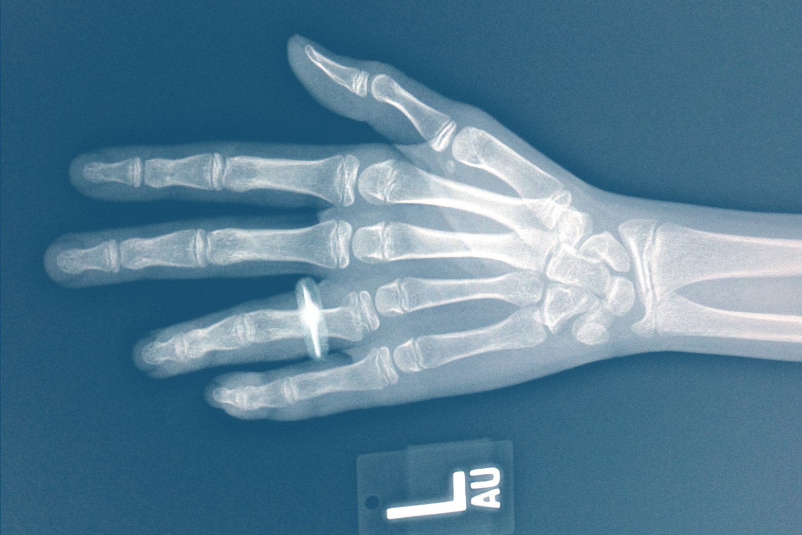 X-ray of a left hand wearing a wedding ring.