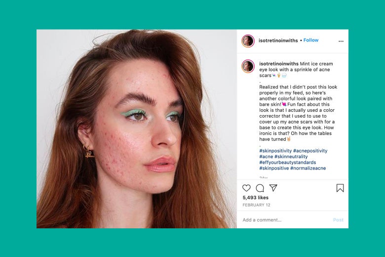 A woman with acne and teal eyeliner.