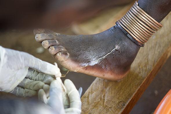 Extracting a Guinea worm is a slow and painful process. 