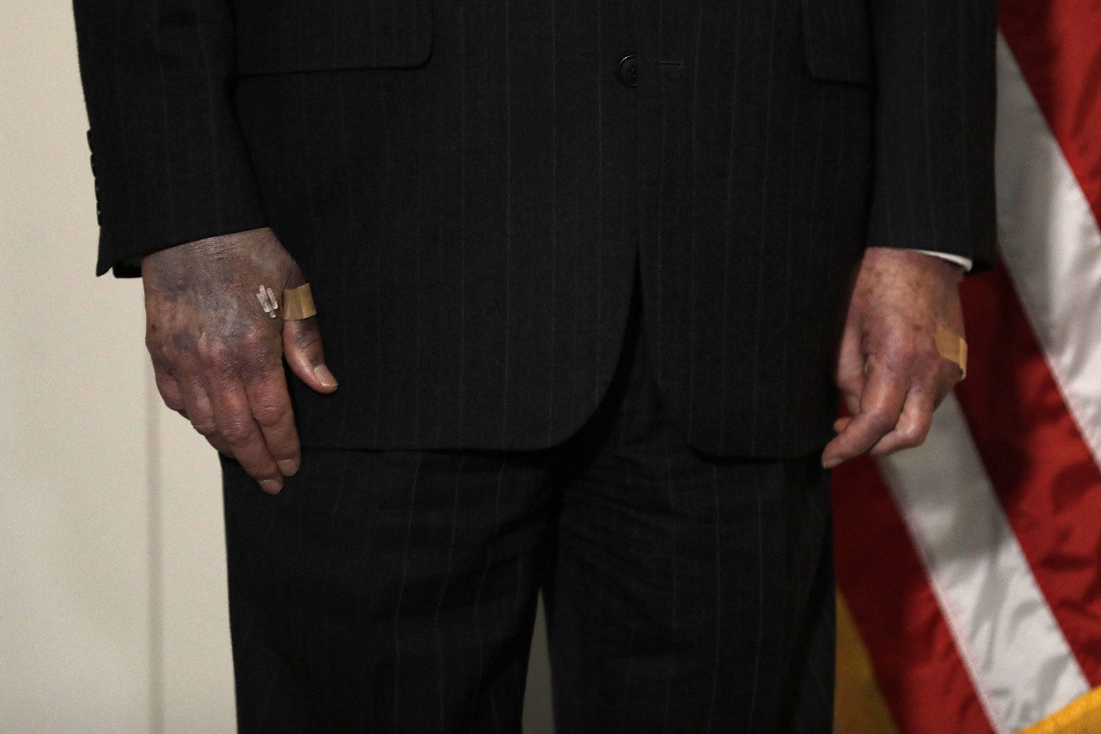 Close-up of Mitch McConnell's bandaged hands. The right hand is bruised to a purplish hue.