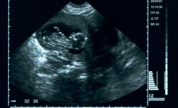 Ultrasound viewing before an abortion: A new study finds that for a ...