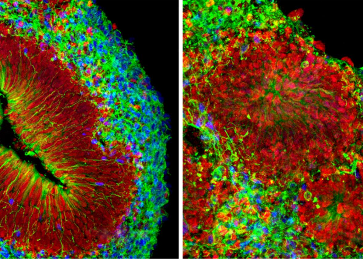 At right, is a Zika virus infection, which destroyed layers of a cultured mini-brain, left.