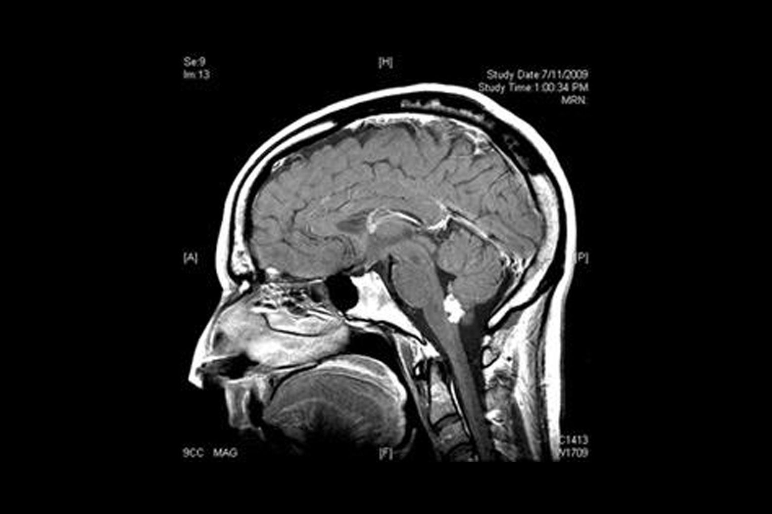 Author's brain scan with the “suspicious hyperdense lesion.” 