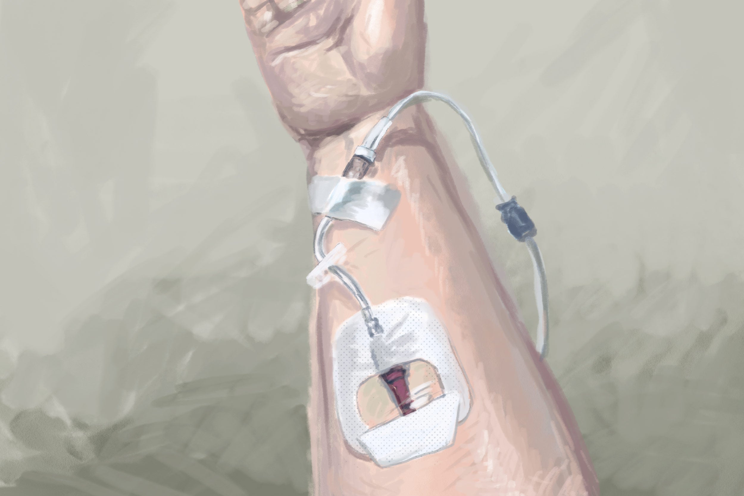 A drawing of an IV going into a forearm.