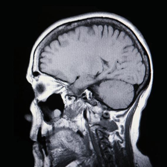 Medical MRI Image Showing Brain and Skull